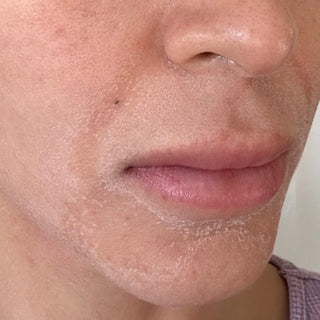 Common Causes of Dry Skin
