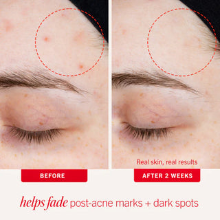 Ultimate Acne Solutions Routine