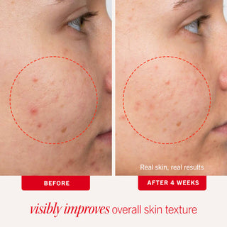 Acne Clearing Pads with 2% Salicylic Acid