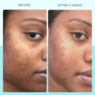 Before and After comparison after 2 weeks of using Dark Spot Serum with Niacinamide.
