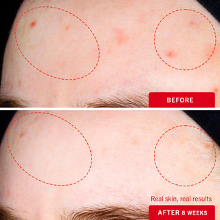 Ultimate Acne Solutions Routine