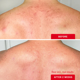 Ultimate Acne Solutions Routine