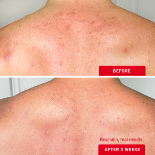 Body Acne Clearing Mist with 2% Salicylic Acid