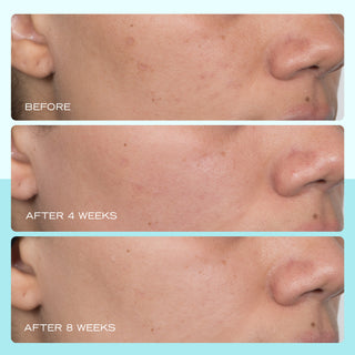Results of using Dark Spot Serum with Niacinamide after 4 weeks and 8 weeks.