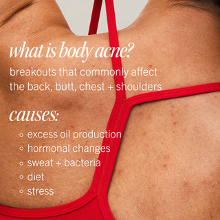 Body Acne Clearing Mist with 2% Salicylic Acid