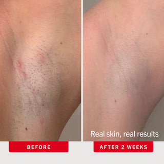 Ingrown Hair Pads with BHA + AHA