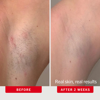 Ingrown Hair Pads with BHA + AHA Travel Size