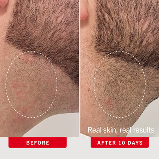 Ingrown Hair Pads with BHA + AHA Travel Size
